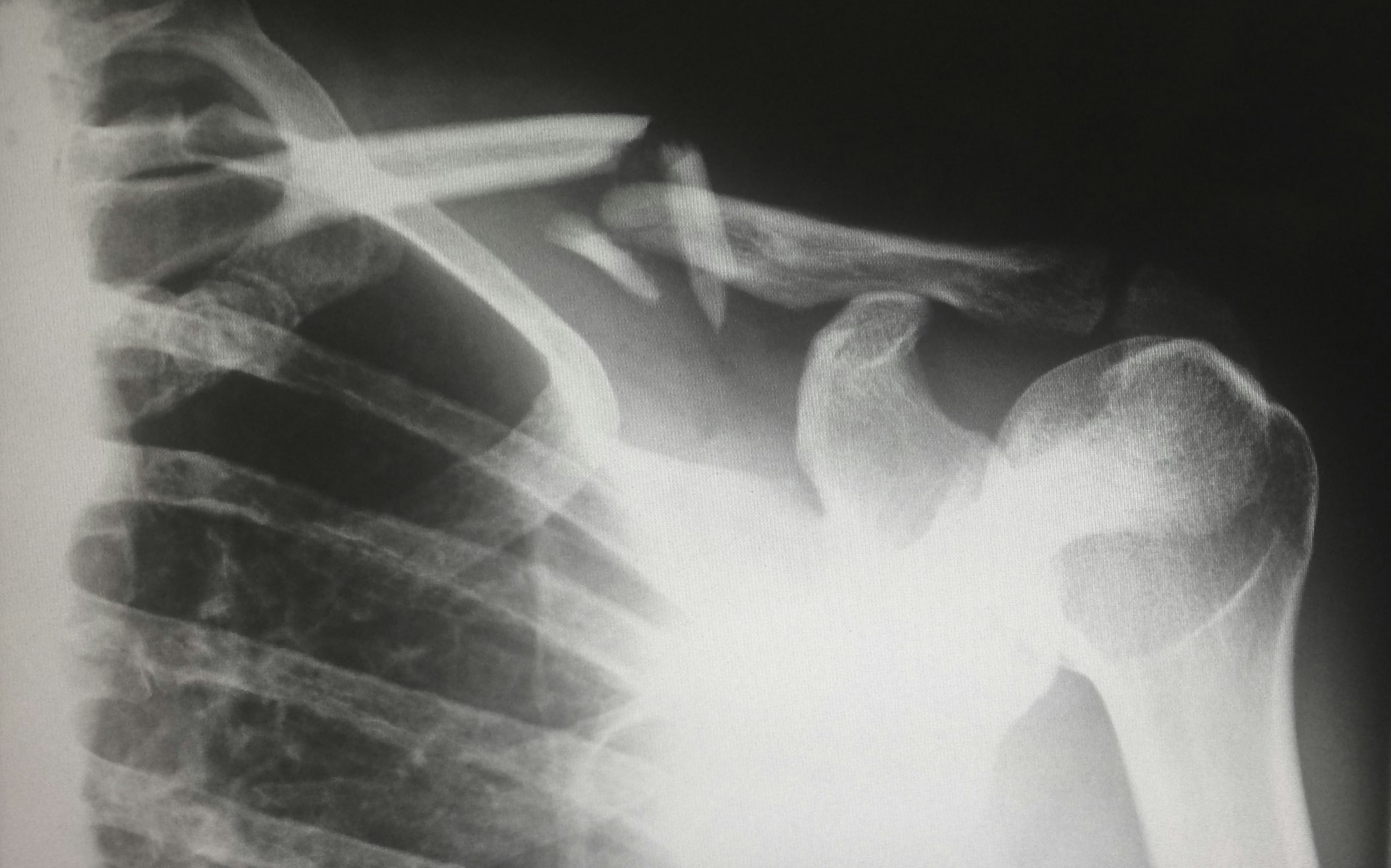 Broken collarbone x-ray
